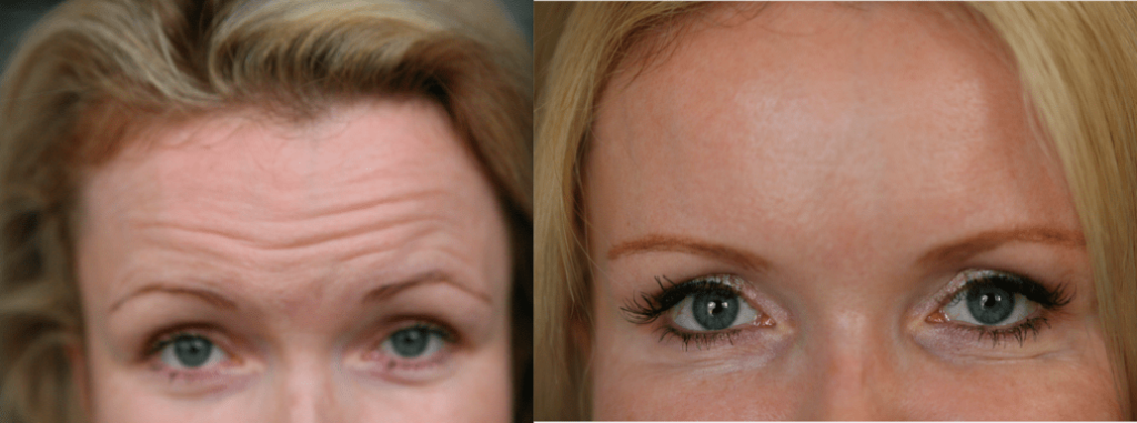 Botox Xeomin Botulinum injections face eyes treatment antiaging wrinkles Conroe Spring Woodlands