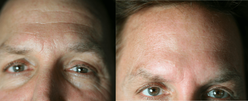 Botox Xeomin Botulinum injections face eyes treatment antiaging wrinkles Conroe Woodlands